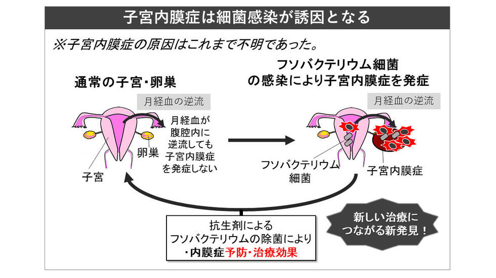 子宮内膜症